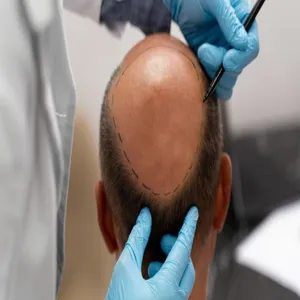 Types of Hair Transplants: Find the Right Option for You