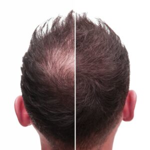 Revitalize Your Hair - Hair Regrowth at Keva Hair Clinic Coimbatore