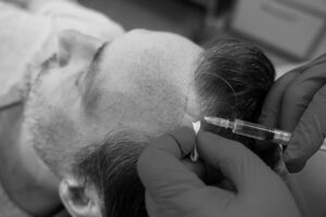 How GFC Treatment in Coimbatore Can Reverse Hair Loss Naturally
