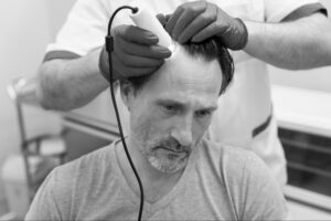 Best Hair Treatment in Coimbatore for Hair Fall and Baldness