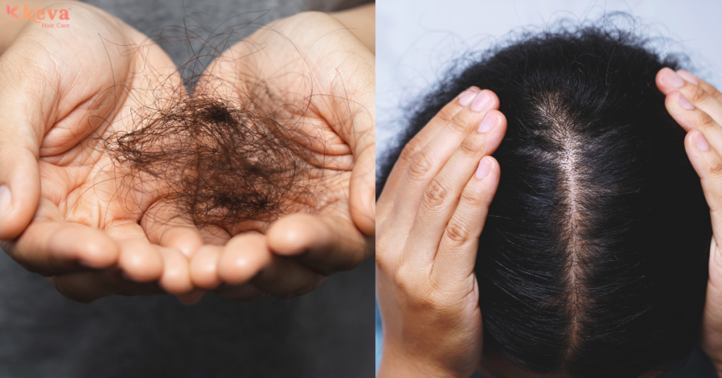 Stress-Induced Hair Loss Solved with PRP: A Working Woman’s Story