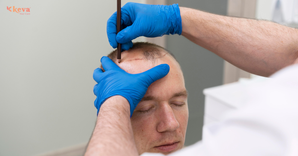 Best Hair Transplant Clinics in Coimbatore