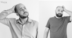 What Is Androgenic Alopecia? Causes, Symptoms & Treatments in Coimbatore