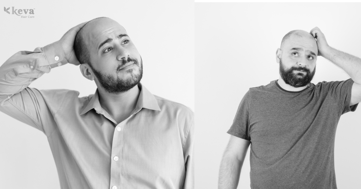 What Is Androgenic Alopecia? Causes, Symptoms & Treatments in Coimbatore