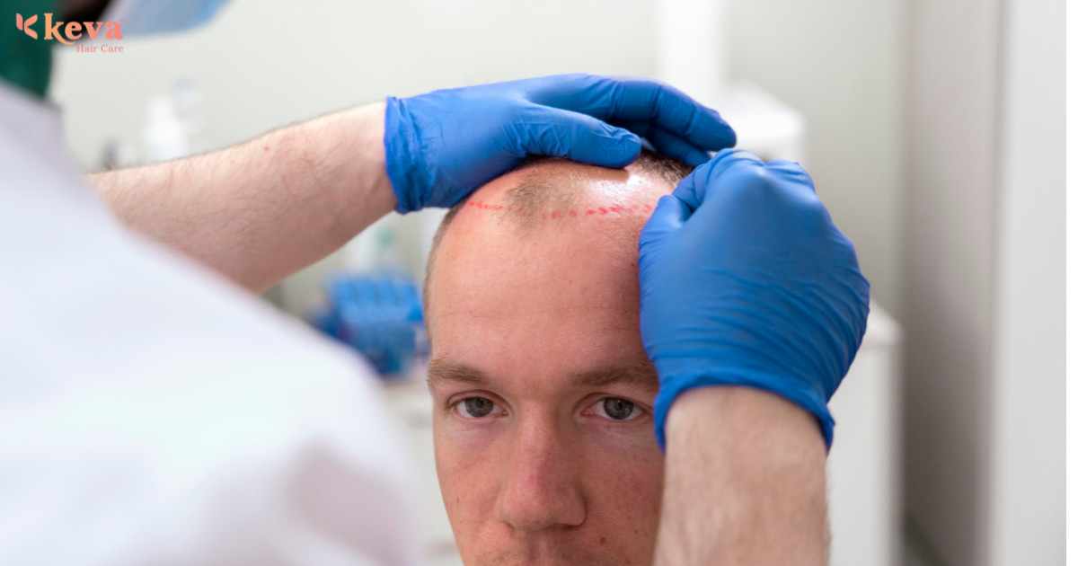 Sapphire Hair Transplant Cost in Coimbatore: What to Expect in 2025
