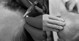 Hair Transplant Cost in Coimbatore (2025)