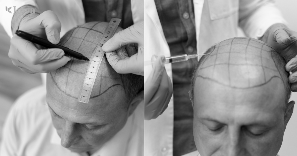 Inside Coimbatore’s Best Hair Transplant Clinics: Technology, Doctors & Patient Results