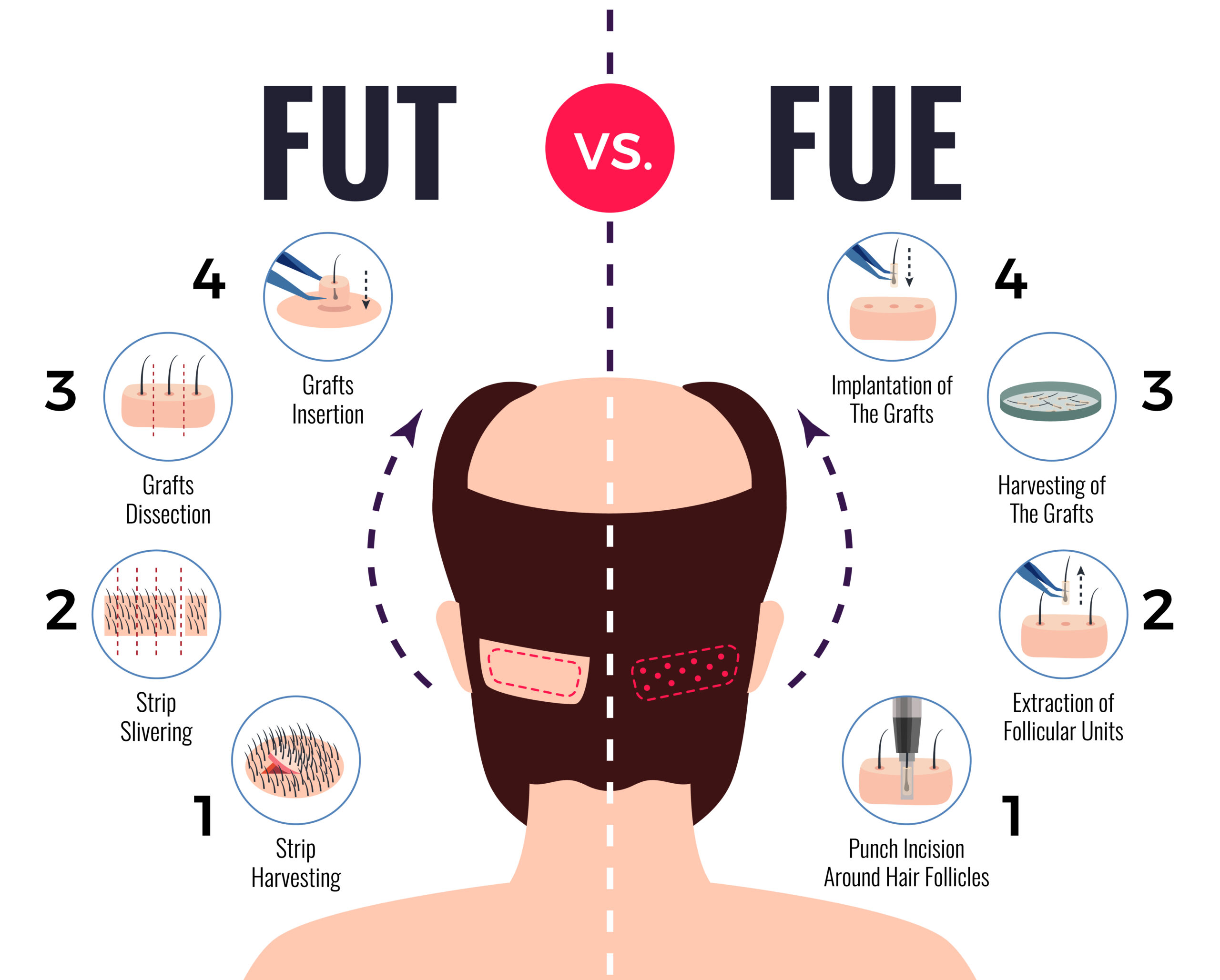 FUE vs FUT: Which Hair Transplant is Right for You at the Best Hair Care Clinics in Coimbatore?