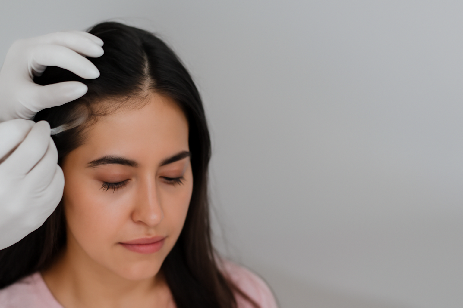 Women’s Hair Transplant in Coimbatore