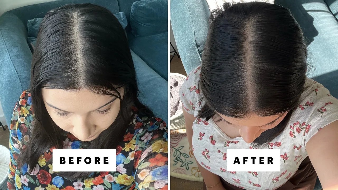 PRP for hair growth-lead