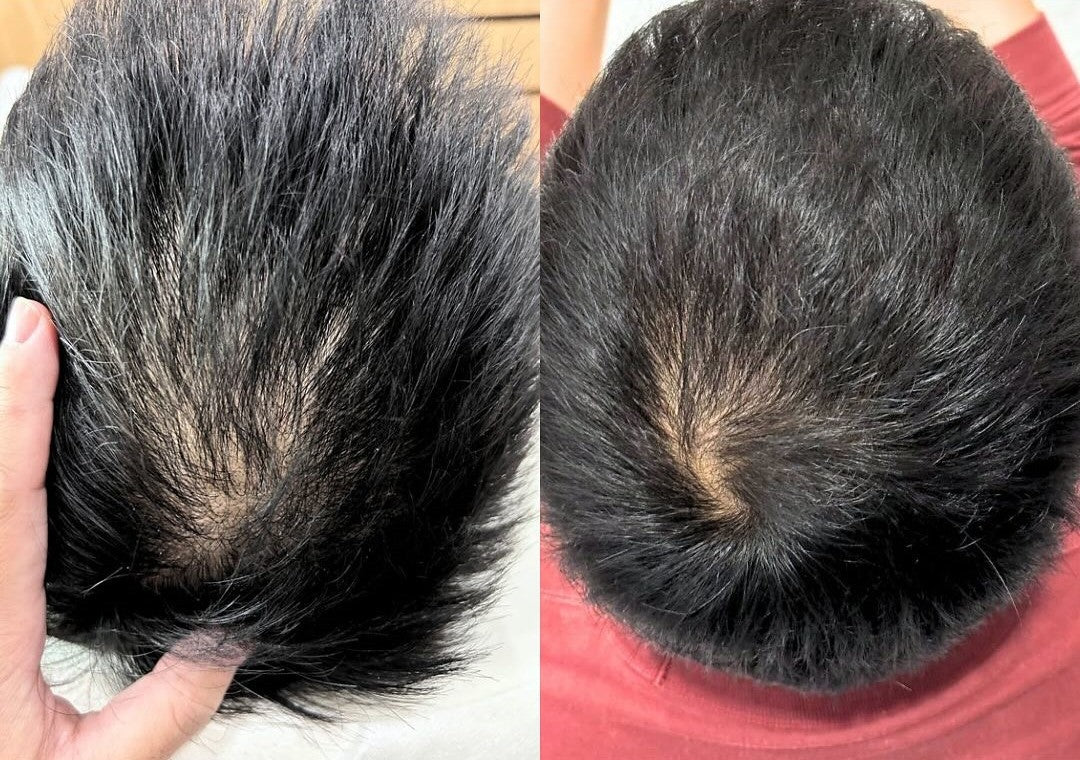 Hair Premium PRP vs Regular PRP