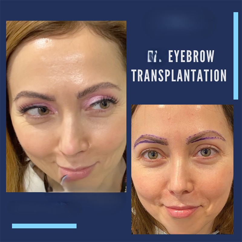 Eyebrow hair Transplant