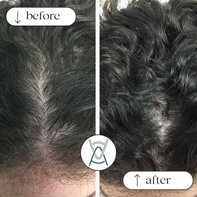 hair regrowth treatment
