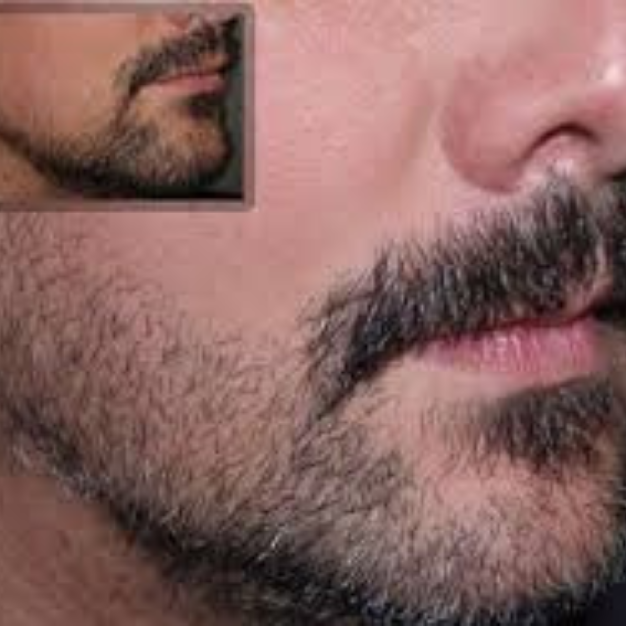 Mustache Transplant