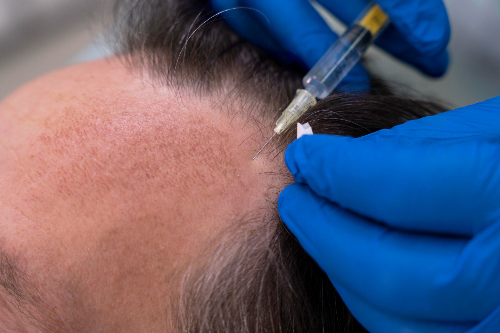 Scalp Micro Pigmentation