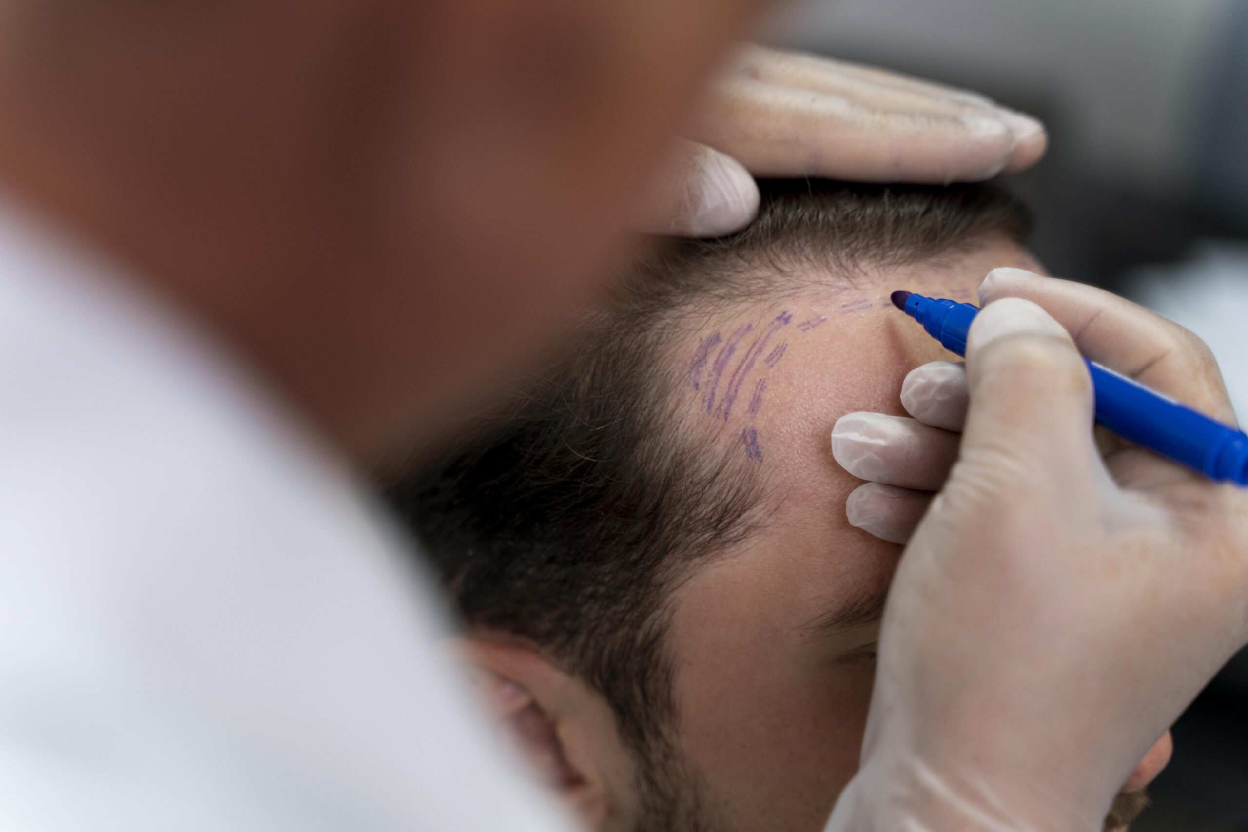 Sapphire Hair Transplant