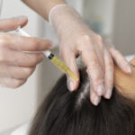 PRP for hair loss