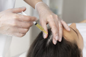 PRP for hair loss