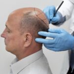 FUE vs DHI hair transplant