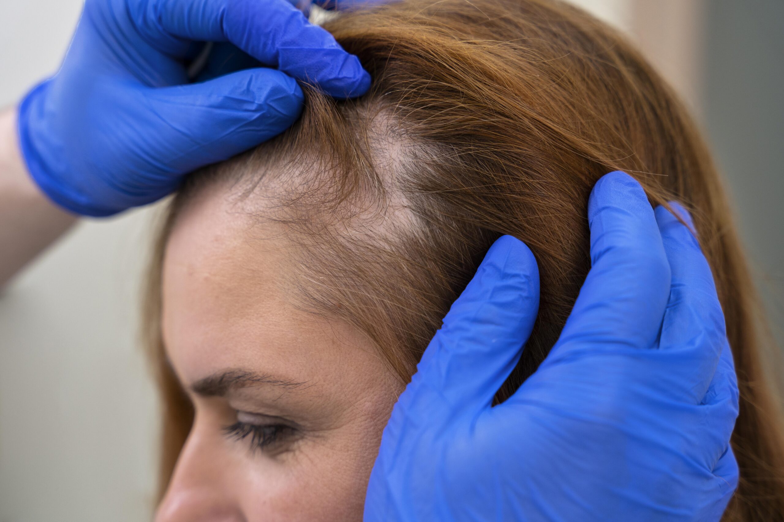 Alopecia Areata