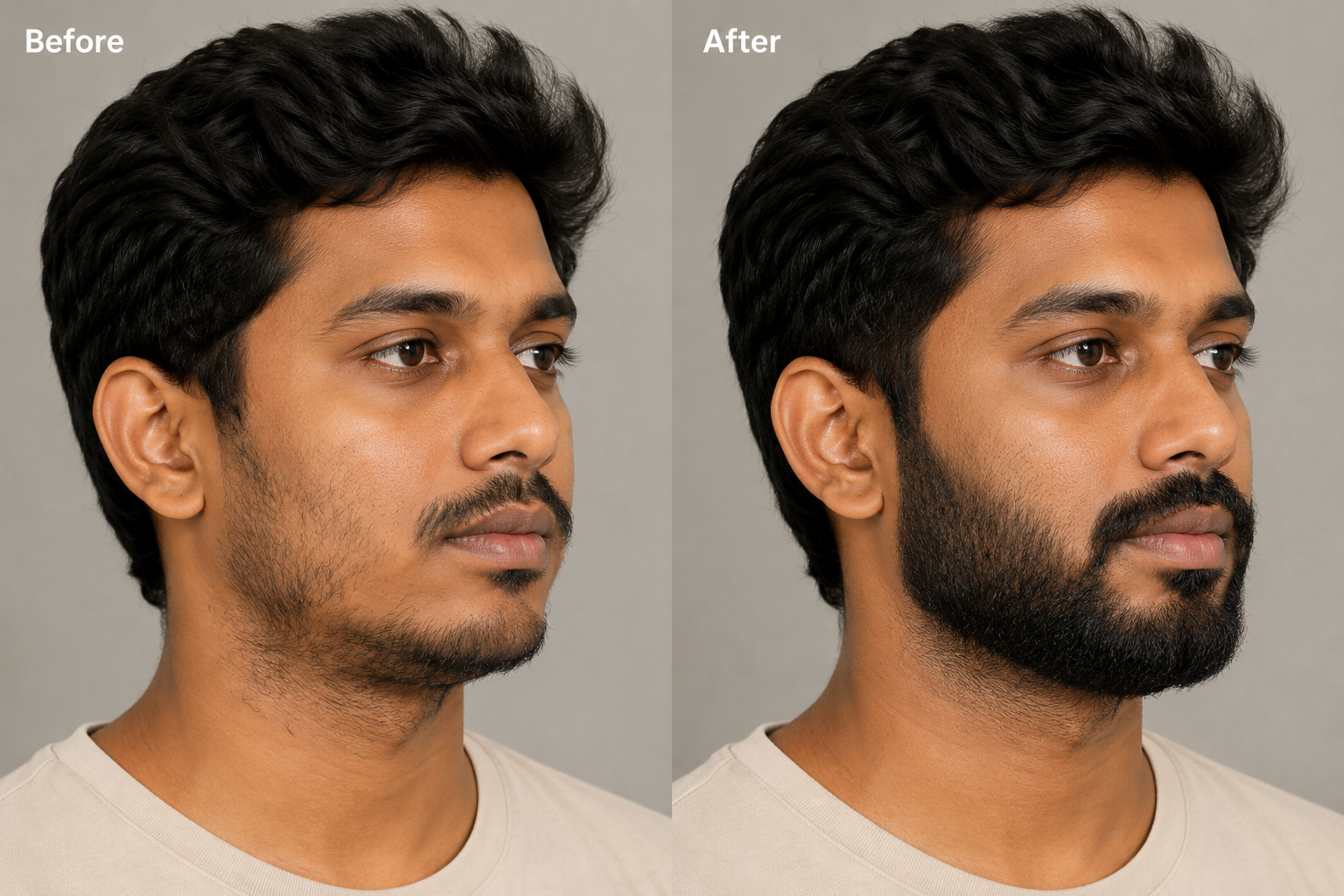 Beard Transplant