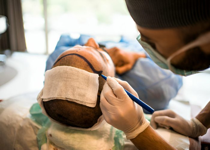 Hair Transplant Procedures