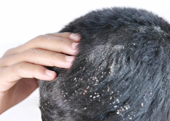 Anti Dandruff Treatment ​