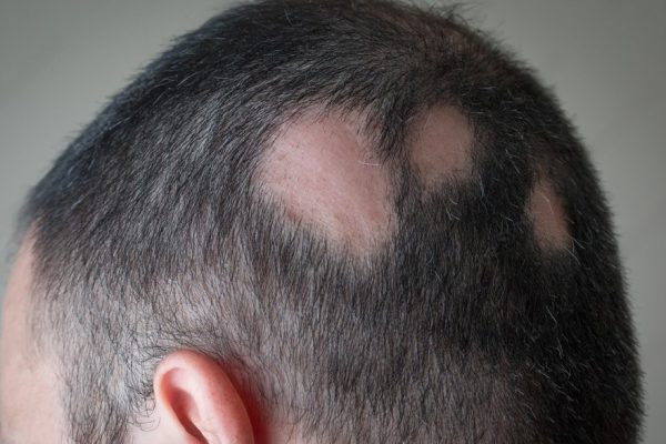 Hair Alopecia Therapy